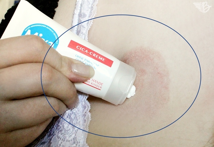 Rash-application-crème-névrodermite